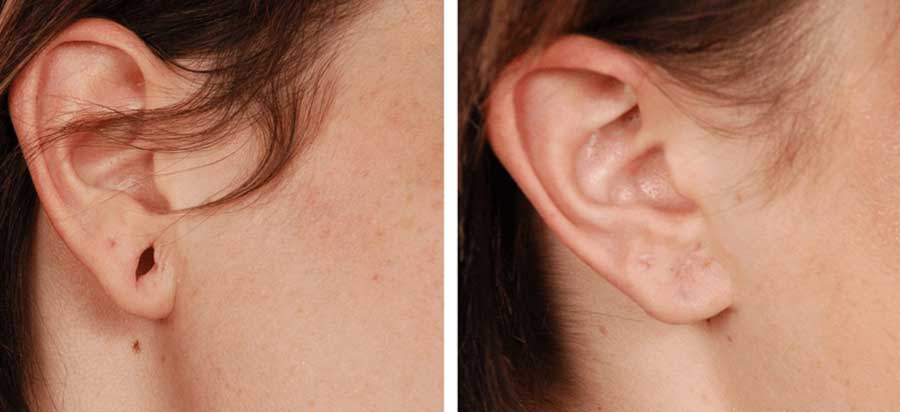 Ear Lobe Repair in Goregaon East by Dr Isha Katyal ENT